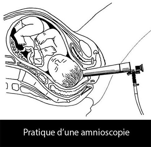 Amnioscopie 1