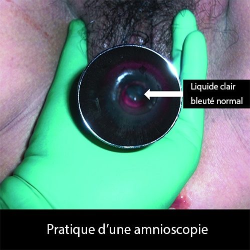 Amnioscopie 5