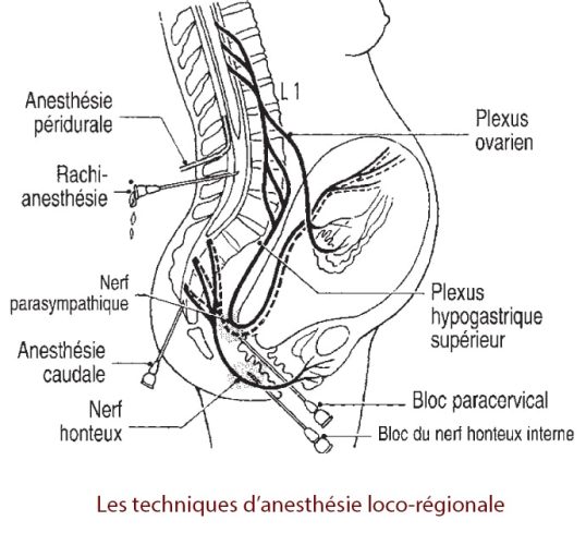 Anesthésie loco-régionale — technique obstétricale péridurale