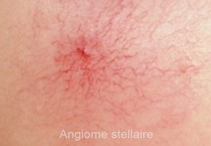angiome stellaire