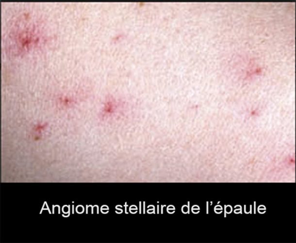 Angiome stellaire