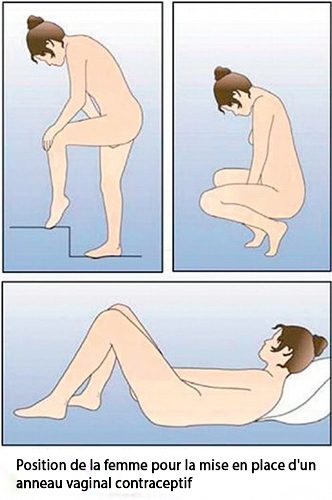 Anneau vaginal contraceptif — NuvaRing pose et retrait 2