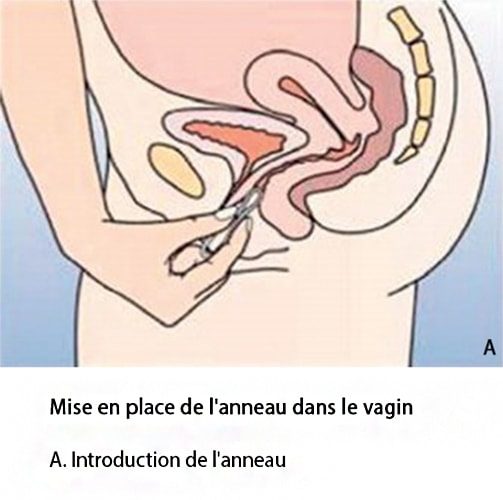 Anneau vaginal contraceptif — NuvaRing pose et retrait 3