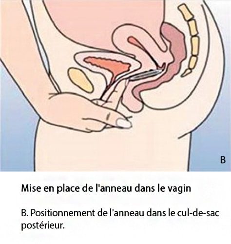 Anneau vaginal contraceptif — NuvaRing pose et retrait 4