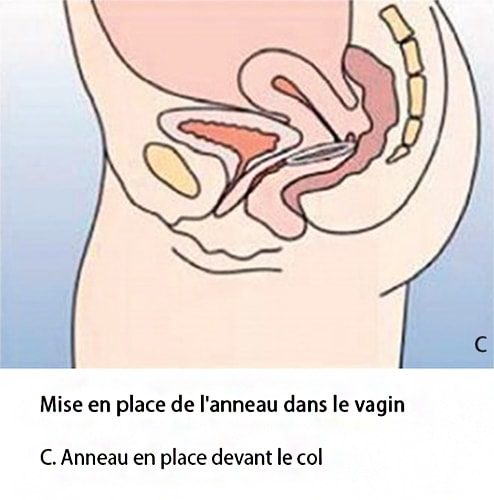 Anneau vaginal contraceptif — NuvaRing pose et retrait 5