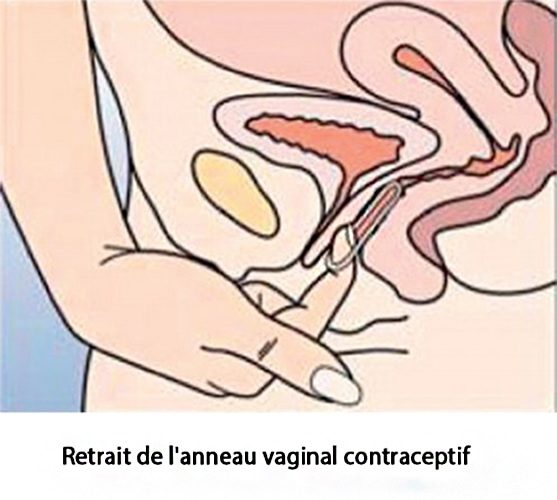 Anneau vaginal contraceptif — NuvaRing pose et retrait 6