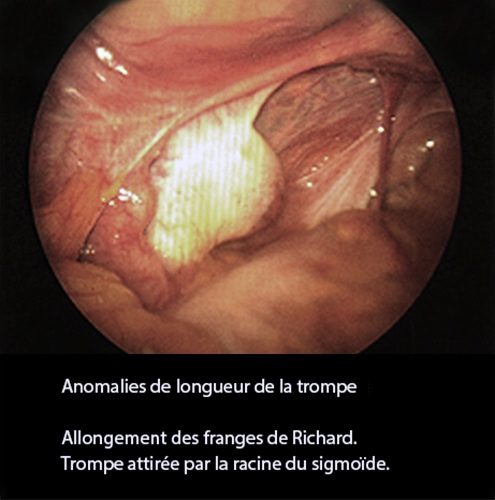 Anomalies longueur trompe — pathologie tubaire coelioscopie 1