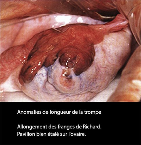 Anomalies longueur trompe — pathologie tubaire coelioscopie 2