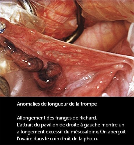 Anomalies longueur trompe — pathologie tubaire coelioscopie 3