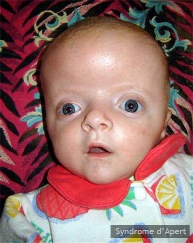 Syndrome d'Apert — craniosynostose et syndactylie malformation congénitale 1
