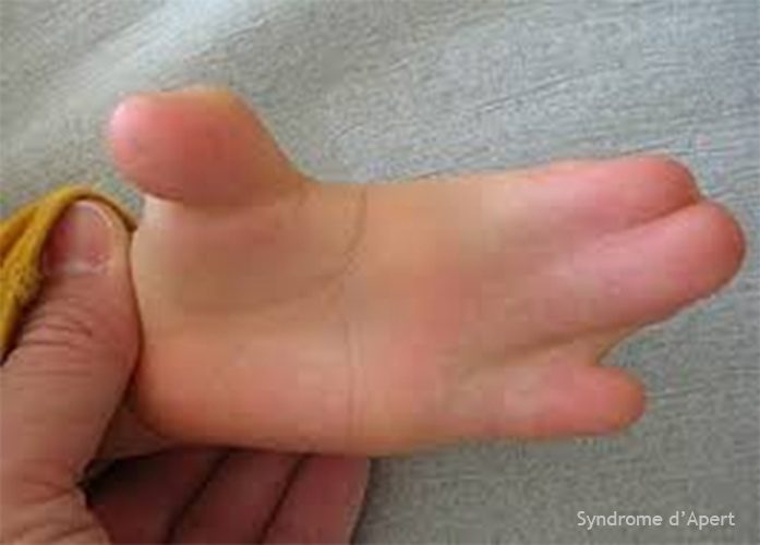 Syndrome d'Apert — craniosynostose et syndactylie malformation congénitale 10