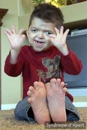 Syndrome d'Apert — craniosynostose et syndactylie malformation congénitale 11