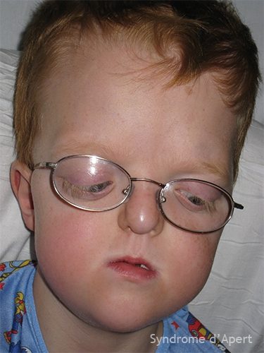 Syndrome d'Apert — craniosynostose et syndactylie malformation congénitale 12