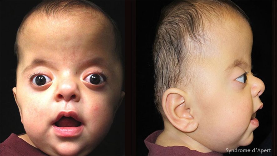 Syndrome d'Apert — craniosynostose et syndactylie malformation congénitale 2