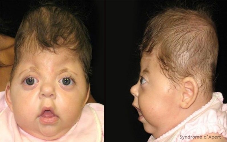 Syndrome d'Apert — craniosynostose et syndactylie malformation congénitale 3