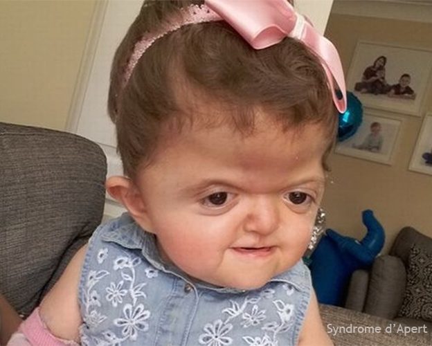 Syndrome d'Apert — craniosynostose et syndactylie malformation congénitale 4