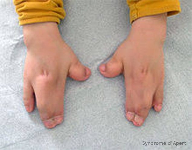 Syndrome d'Apert — craniosynostose et syndactylie malformation congénitale 5