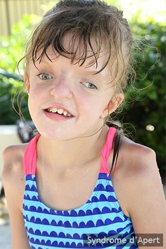 Syndrome d'Apert — craniosynostose et syndactylie malformation congénitale 6