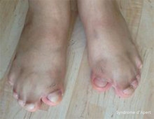 Syndrome d'Apert — craniosynostose et syndactylie malformation congénitale 7