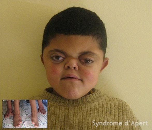 Syndrome d'Apert — craniosynostose et syndactylie malformation congénitale 8