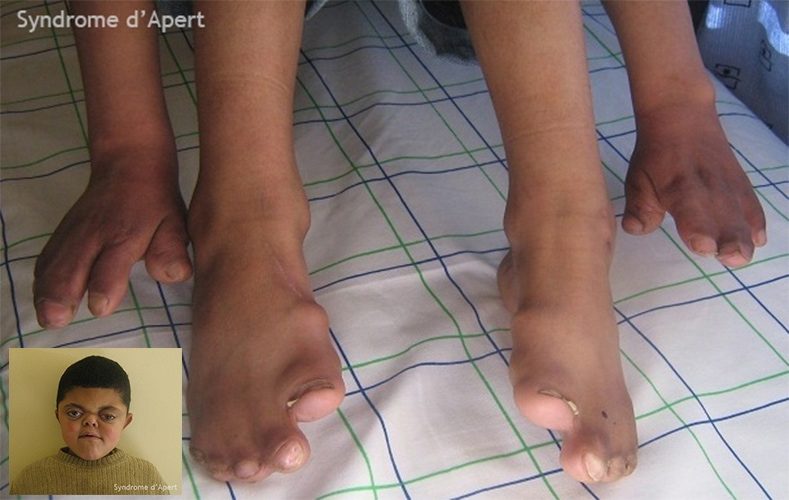 Syndrome d'Apert — craniosynostose et syndactylie malformation congénitale 9