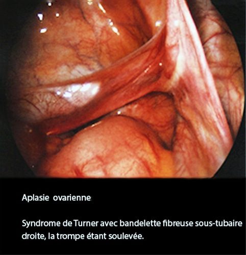 Aplasie ovarienne