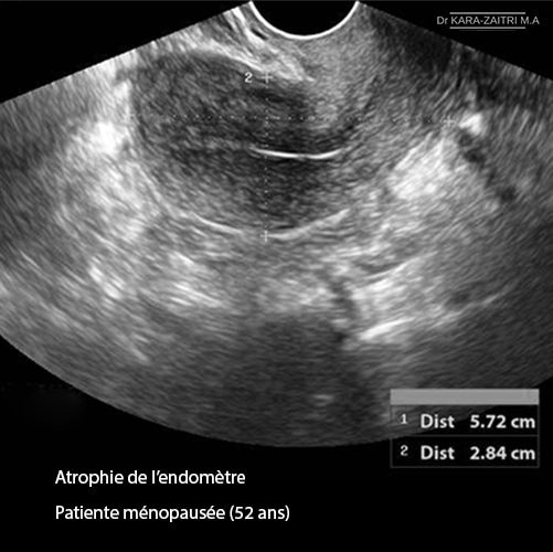 Atrophie endometre 2_menopause