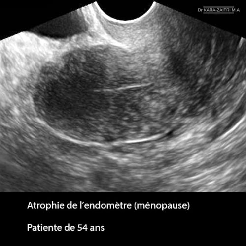 anomalies de la cavité utérine