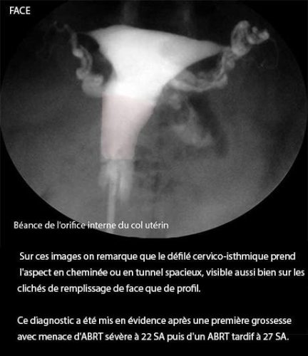 Bilan complémentaire infertilité BCI — hystérosalpingographie 1