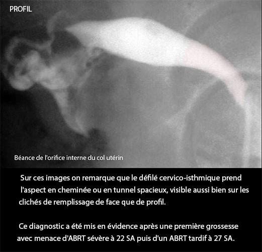 Bilan complémentaire infertilité BCI — hystérosalpingographie 2