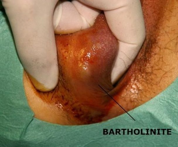 abcès de bartholin