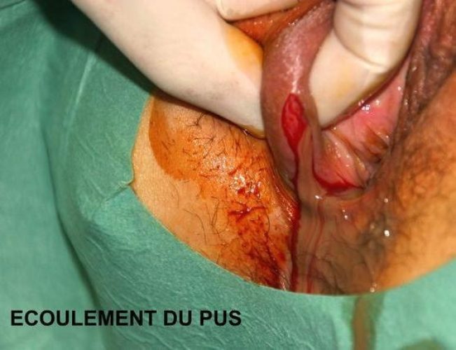 Bartholinite_operation 2