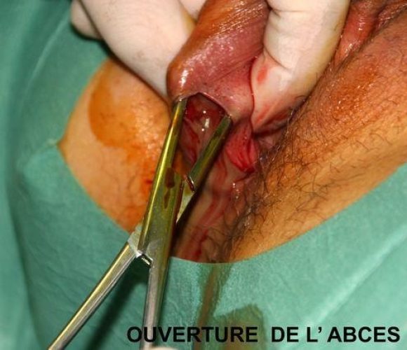 Bartholinite_operation 3