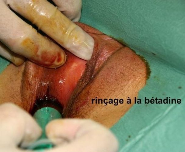 Bartholinite_operation 4