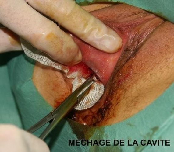 Bartholinite_operation 5
