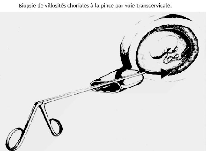 Biopsie du trophoblaste 1