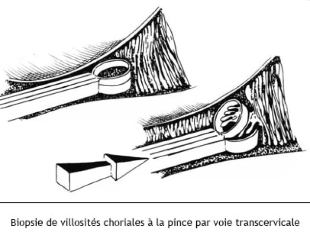 Biopsie du trophoblaste 2
