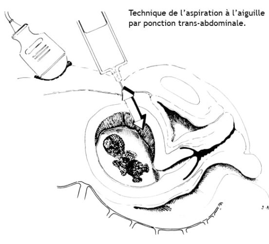 Biopsie du trophoblaste 3