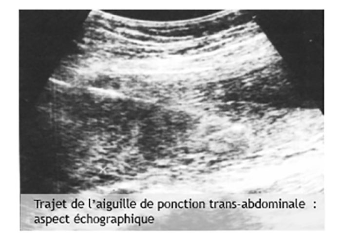 Biopsie du trophoblaste 4