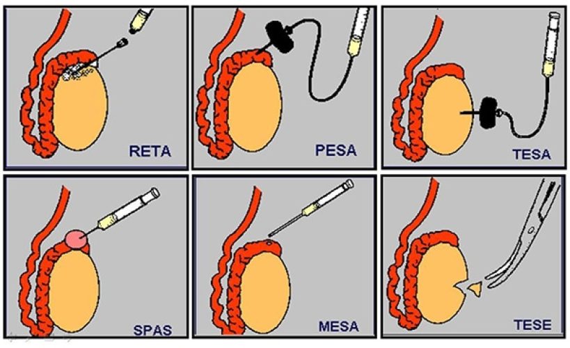 Biopsie testiculaire 2