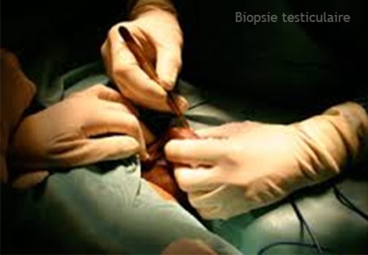 Biopsie testiculaire 3