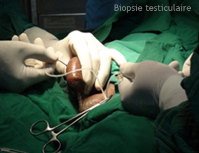 Biopsie testiculaire 4
