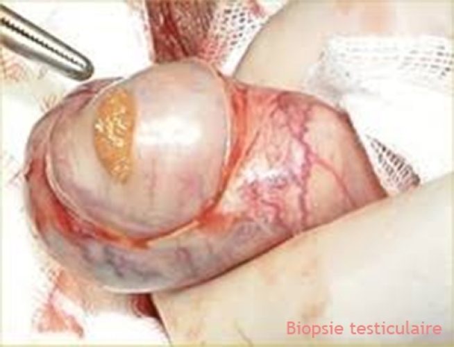 Biopsie testiculaire 5