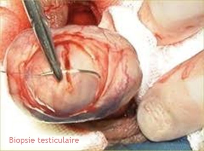Biopsie testiculaire 6