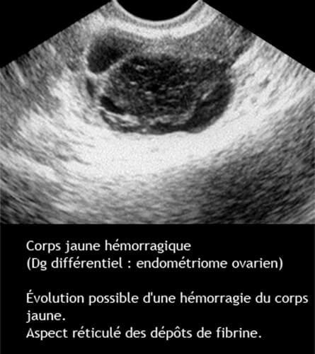 CJ hémorragique 2