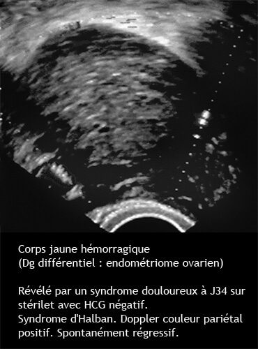 Corps jaune hémorragique — kyste du corps jaune compliqué échographie