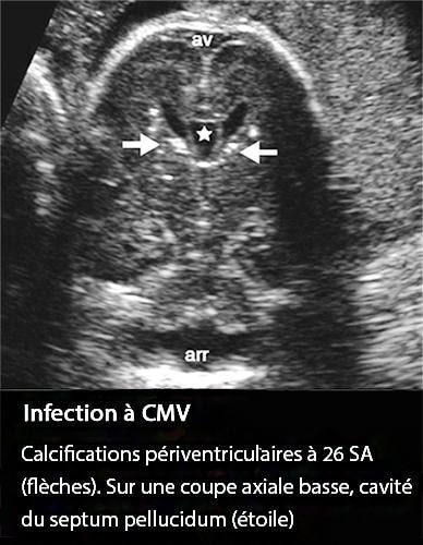 CMV cytomégalovirus — manifestations cliniques infection congénitale 1