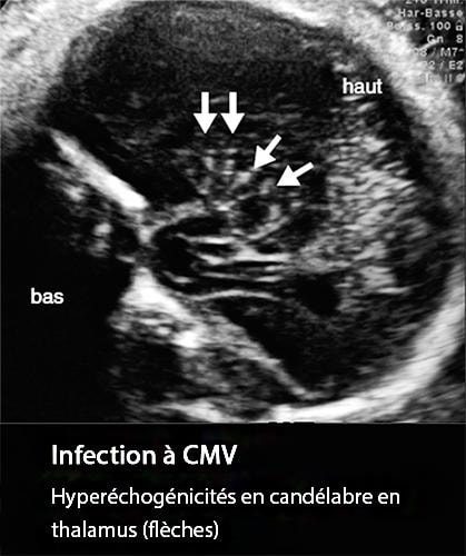 CMV 2