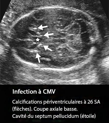 CMV 3