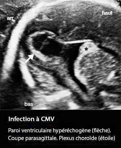 CMV 4